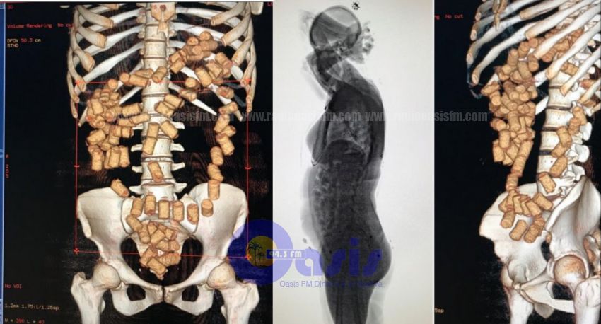 En Foz detienen a una abogada paraguaya con cocaína en el estómago