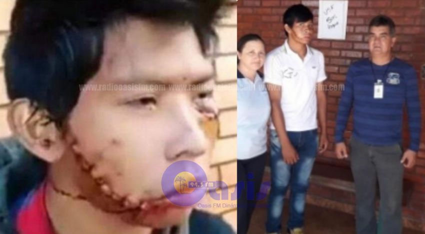 Cirugía reconstructiva para indígena con corte de arma  blanca  ocurrido en Amambay