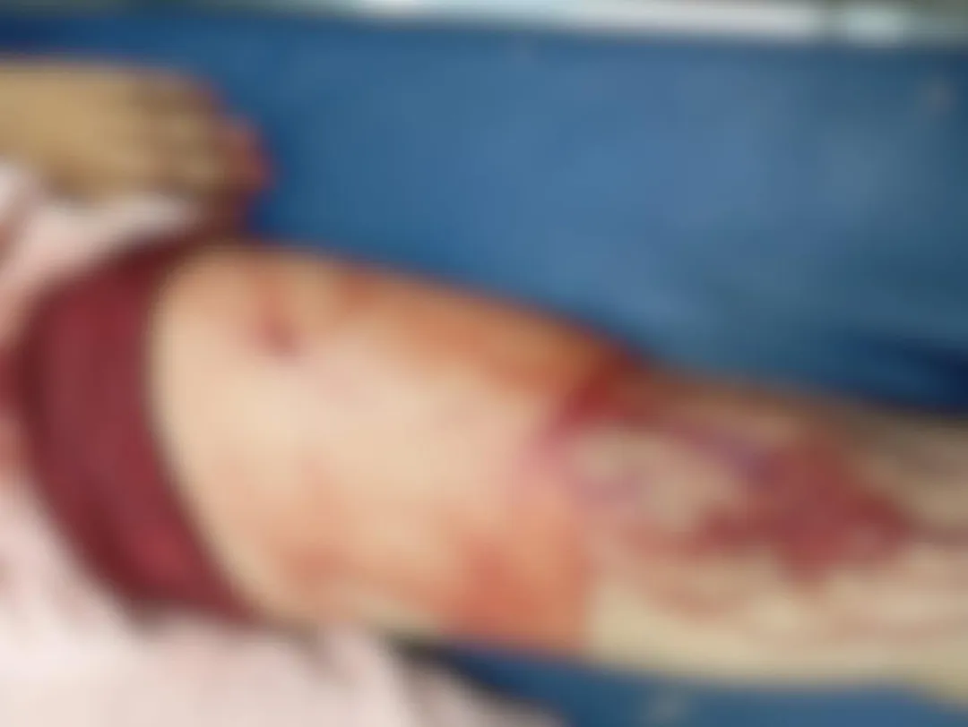 Hieren en el muslo a joven víctima de asalto