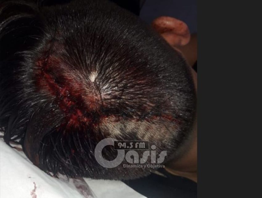 Joven quedo con traumatismo de cráneo tras accidente en Pedro Juan