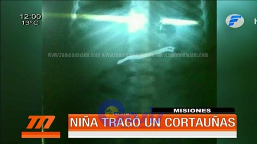 Beba tragó parte de un alicate