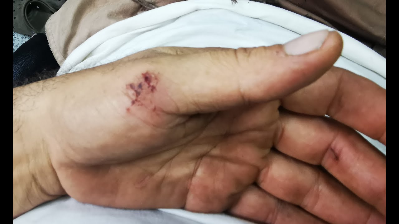 Salud registra 717 accidentes por animales ponzoñosos en lo que va del año