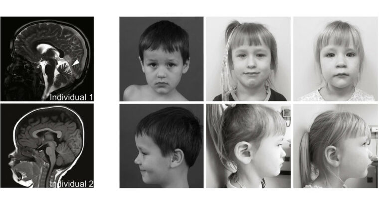 Descubren una nueva rara enfermedad neurológica